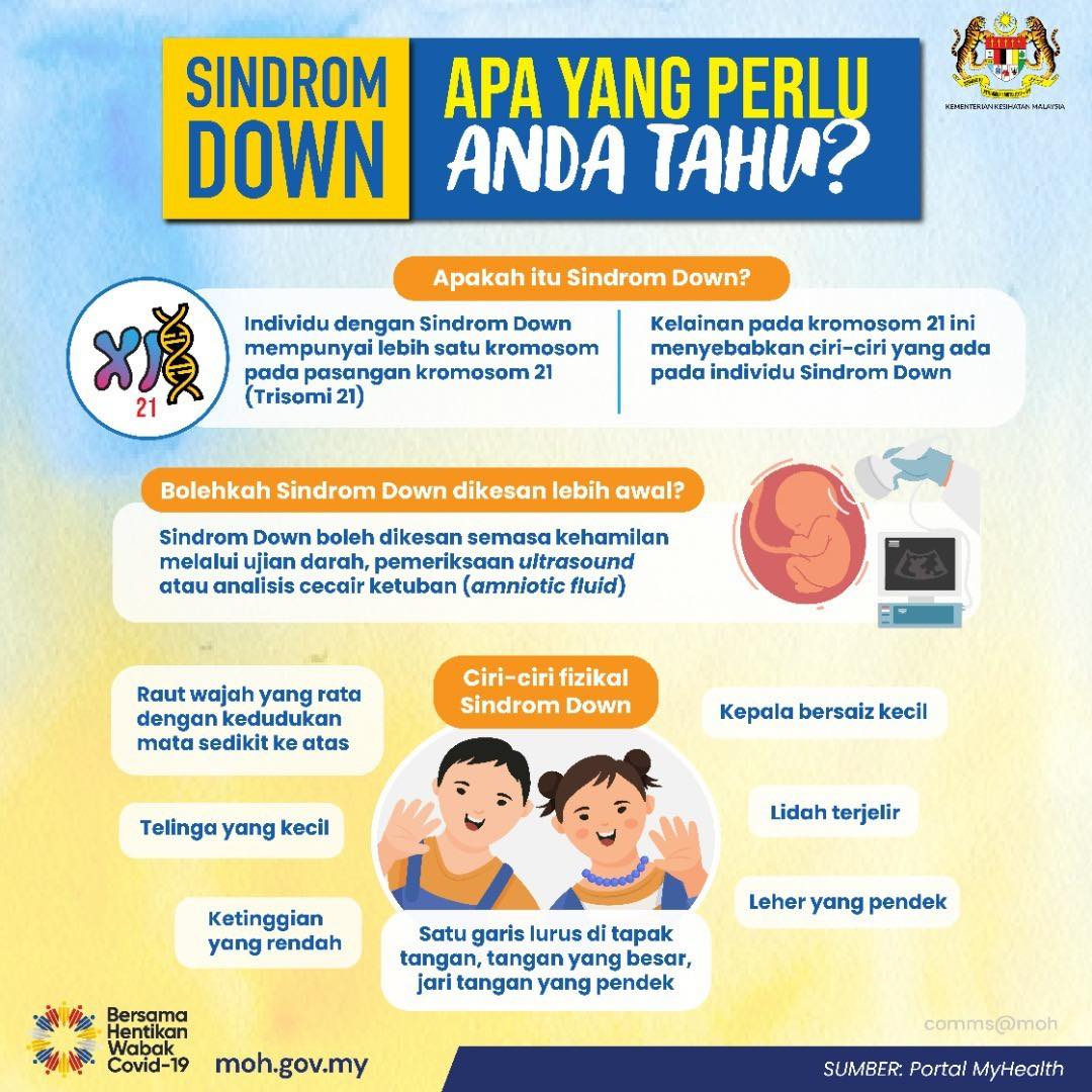 SINDROM DOWN